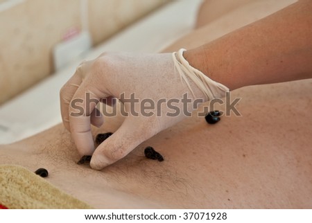 Photo of doctor planting leeches on patient