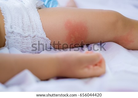 Leg of sleeping Small child with redness on the skin, suffering from food allergies, \
Baby\'s leg covered by eczema. allergy baby skin dermatitis food. Unrecognizable dermatitis symptom problem rash.