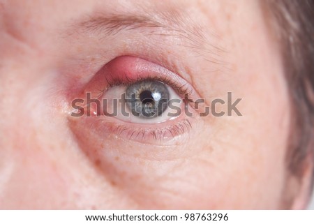 A Infected Eye