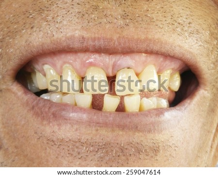 Old man with a tooth broken