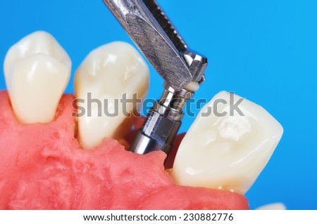 tweezers holding dental implant implanted in jaw bone