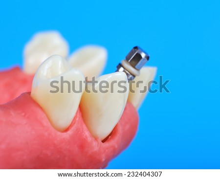 Dental titanium implant implanted in jaw bone