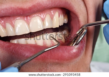patient open mouth before oral inspection with hook and mirror