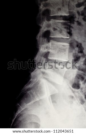 L5-S1 herniated disc (reduced inter-vertebral space) X-ray image