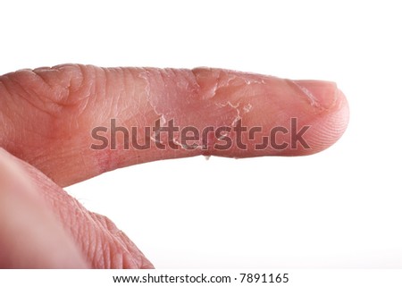 Peeling Skin Hands