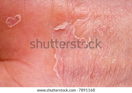 eczema on male hand with skin peeling