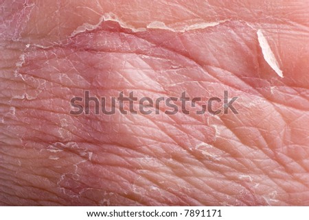 macro of eczema on male grip with skin peeling