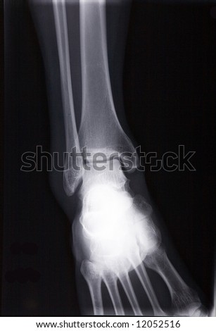 human male ankle xray picture