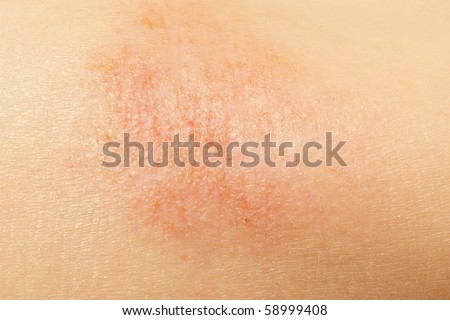 macro of eczema on little girl arm skin