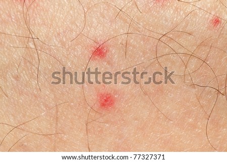 detail of mosquito spot allergy on mature man  skin