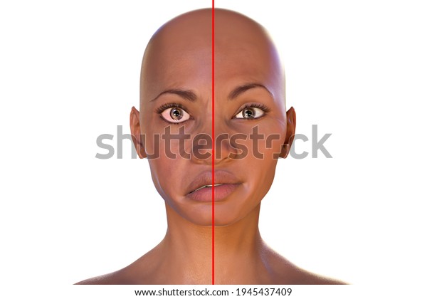 Facial Nerve Paralysis Bells Palsy 3d Stock Illustration 1945437409