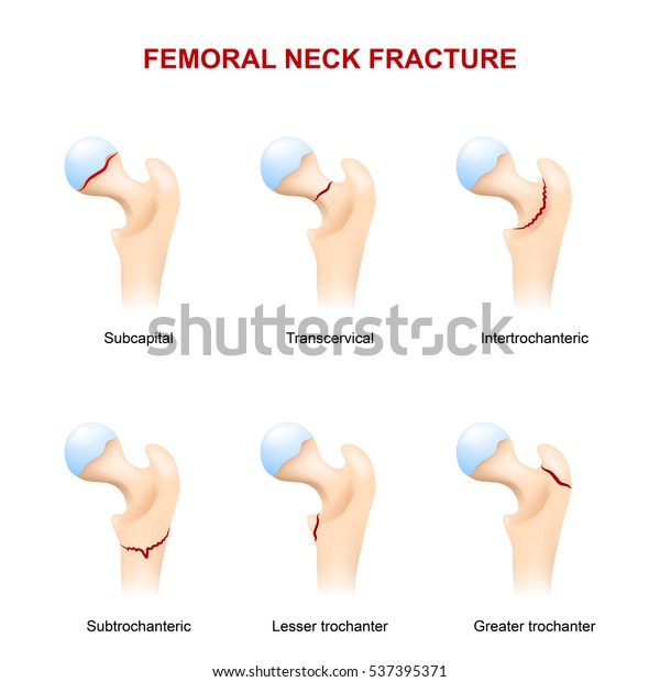 Femoral Neck Fracture Major Types Stok İllüstrasyon