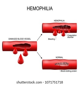 Hemophilia Damaged Blood Vessel Haemophilia Coagulation Stock