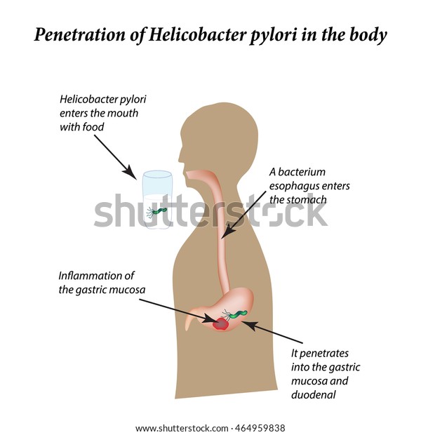 Infection Helicobacter Pylori Infographics Illustration On Stock