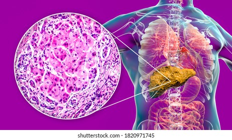 H Gado Con Cirrosis Dentro Del Cuerpo Ilustraci N De Stock