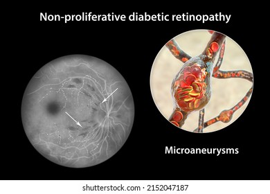 Nonproliferative Diabetic Retinopathy D Illustration Showing Stock