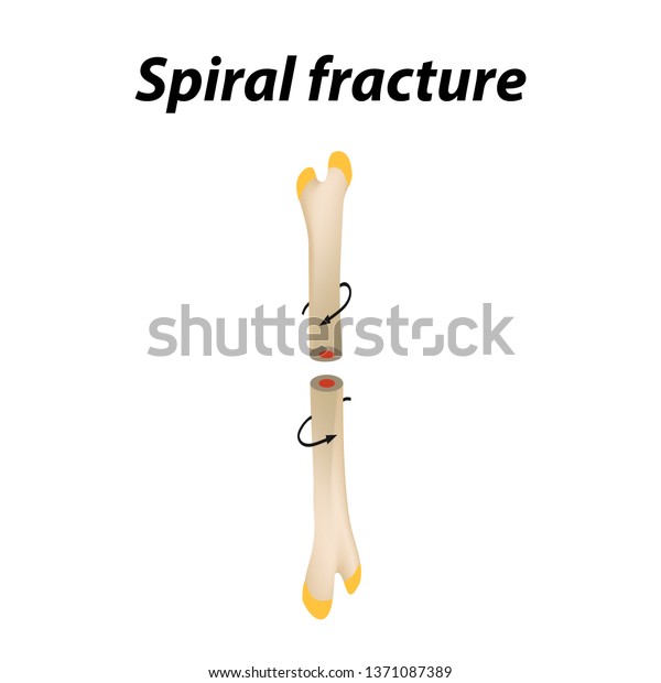 Spiral Bone Fracture Infographics Illustration On Stock Illustration