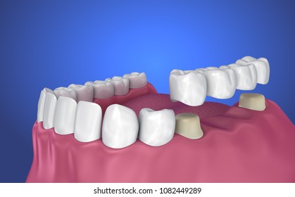 Tooth Supported Fixed Bridge Medically Accurate Stock Illustration