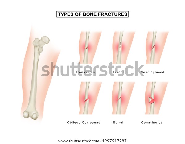 Types Bone Fractures Femoral Shaft Fracture ilustrações stock