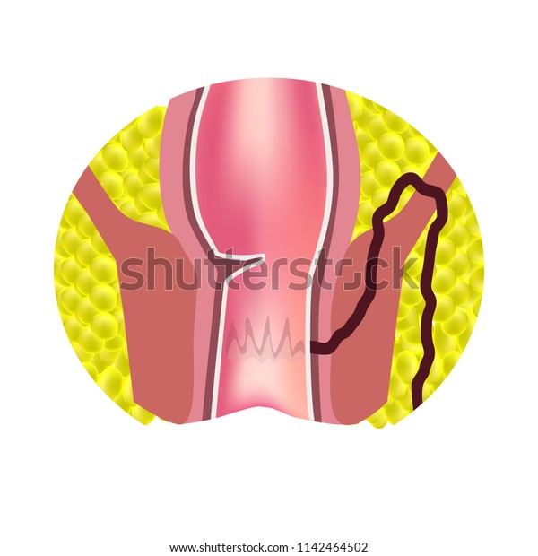 Types Fistulas Rectum Paraproctitis Anus Abscess ภาพประกอบสตอก