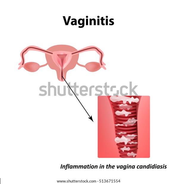 Vaginitis Inflammation Vagina Candidiasis Thrush Structure 스톡 일러스트