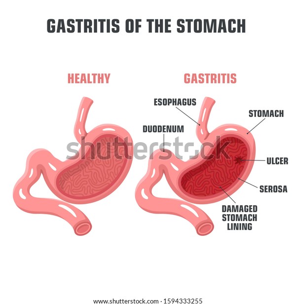 Vector Medical Icon Stomach Anatomy Image Normal And Gastritis Stomach