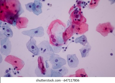 Trichomonas Pap Smear Cytology View Microscopicgynecology Foto De Stock