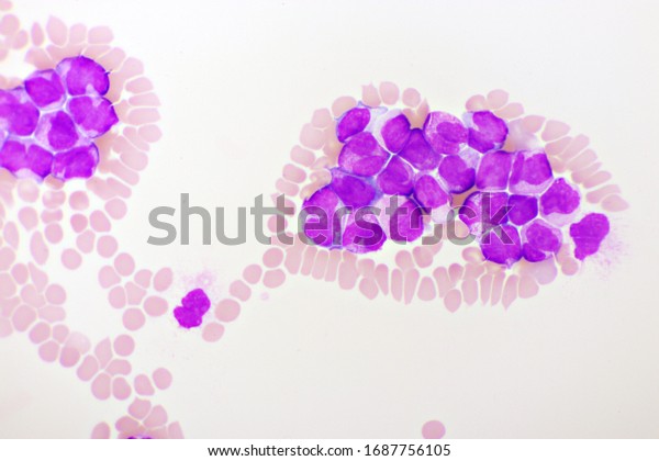 Acute Promyelocytic Leukemia Cells Apl Analyze Stock Photo Edit Now