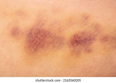 Bruises On Human Body Severe Bruise Stock Photo Shutterstock