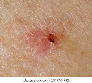 Case Ulcerated Superficial Basal Cell Carcinoma Foto De Stock