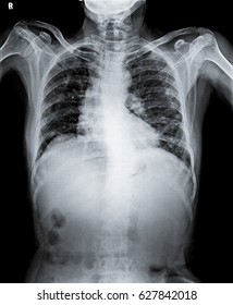 Anteroposterior Chest Radiograph Xray Showing Intercostal Foto Stok