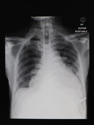 A Chest X Ray Film Of A Female Patient With Cardiomegaly Pulmonary