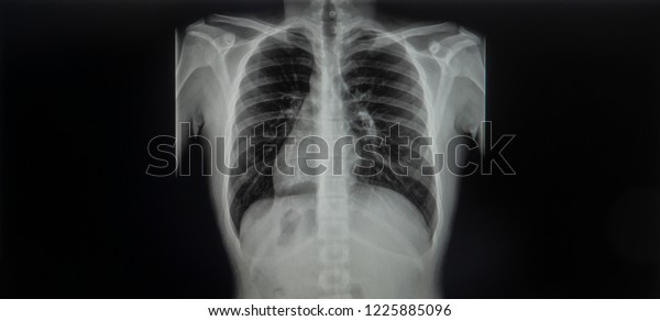 Chest Xray Image Dextrocardia Situs Inversus Stock Photo Edit Now