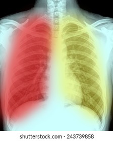 Lung Cancer Pleural Effusion 스톡 사진 1143069200 Shutterstock