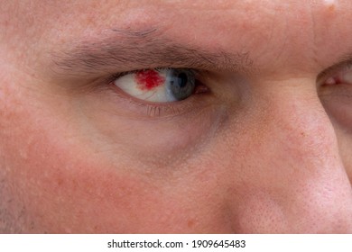 Close Subconjunctival Hemorrhage Red Blood Spot Stock Photo