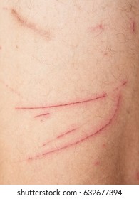 Close Wound On Human Skin Stock Photo Shutterstock