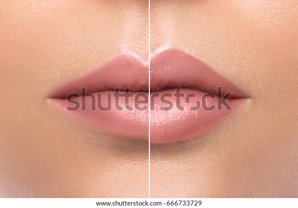 Comparison Female Lips Before After Augmentation Stock Photo Edit Now