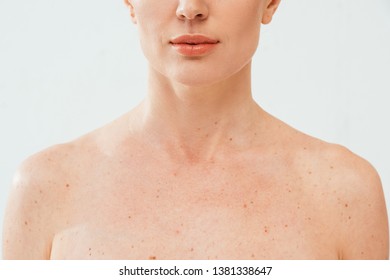 Cropped View Nude Woman Melanoma Isolated Foto Stok 1381338647