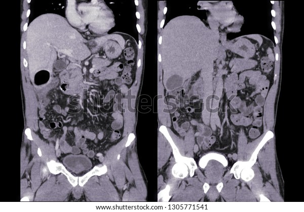 Ct Whole Abdomen Stock Photo 1305771541 Shutterstock