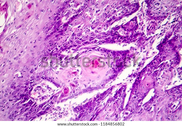 Cutaneous Squamous Cell Carcinoma Light Micrograph Stock Photo Edit