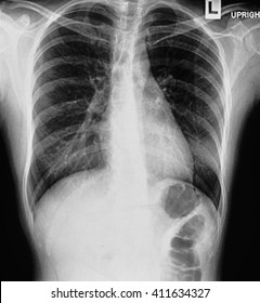 Chest Xray Film Patient Lobar Pneumonia Stock Photo Edit Now