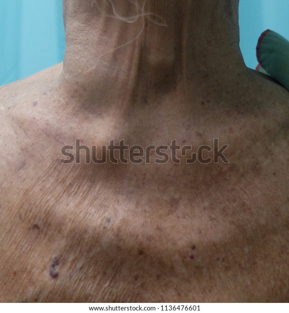 Dilated Superficial Veins Secondary Obstructed Superior Stock