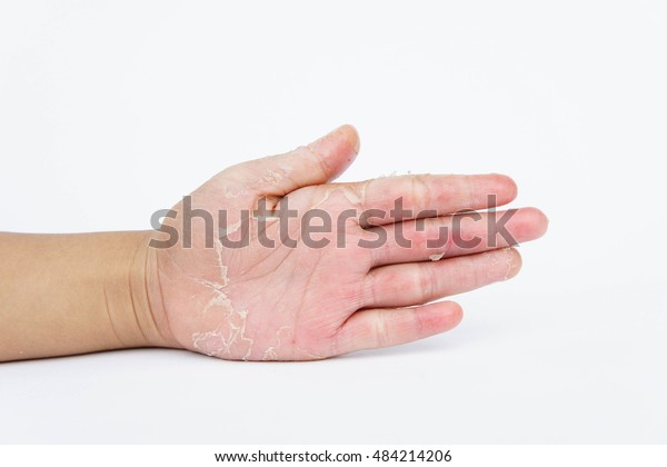 Dry Hands Peel Contact Dermatitis Fungal Stock Photo