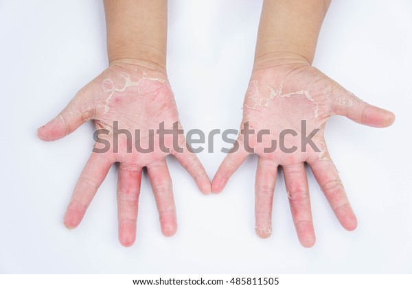 Dry Hands Peel Contact Dermatitis Fungal Stock Photo