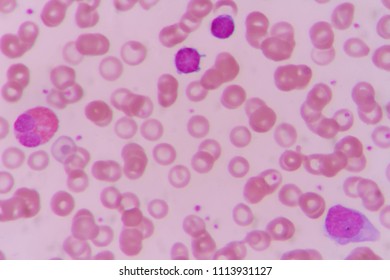 Eosinophil Lymphocyte Blood Smear Under Microscopy Stock Photo