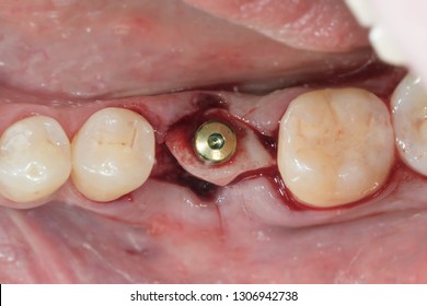 Healing Abutment Stock Photos Images Photography Shutterstock