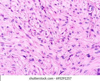 Leiomyosarcoma Malignant Cancerous Smooth Muscle Tumor Stock Photo