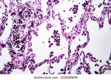 Histopathology Lung Emphysema Light Micrograph Photo Stock Photo