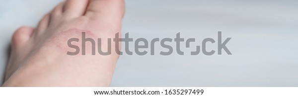 Human Leg Granuloma Annular Pink Lichen Stock Photo Edit Now