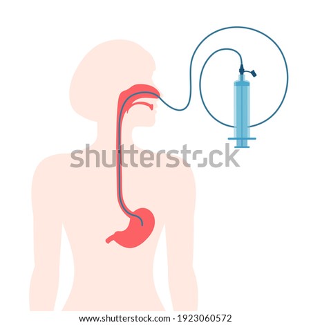 Nasogastric Tube Stock Vector Images Avopix